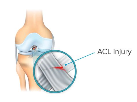 The Importance of ACL Injuries