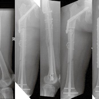 The Multiply Injured Patient with Complex Fractures Reader