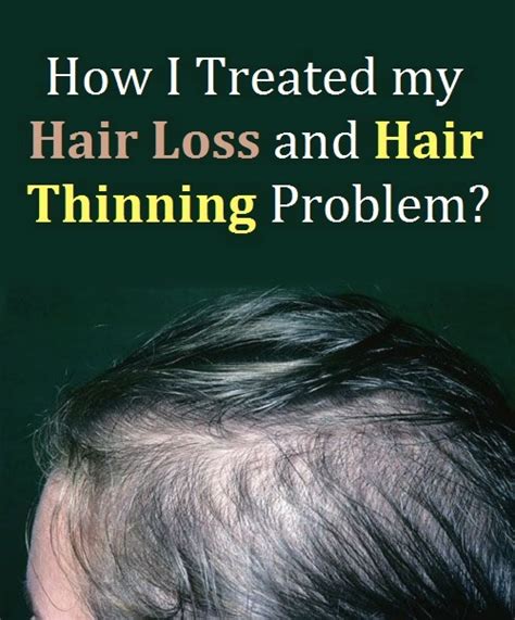 The Problem of Thinning Hair: A Silent Struggler