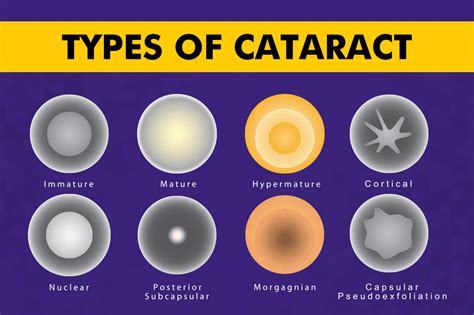 The Rising Prevalence of Cataracts: A Comprehensive Guide to Lao Hua Yan