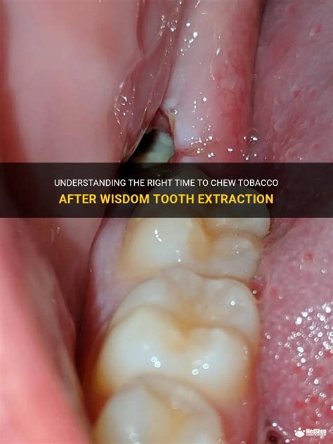 The Risks of Chewing Tobacco After a Tooth Extraction