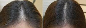 The Science Behind Hair Thinning