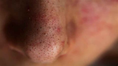 The Ultimate Guide to Removing Stubborn Blackheads: A Comprehensive Approach