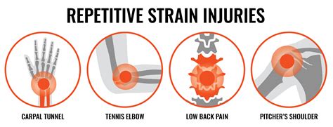 The Ultimate Guide to Repetitive Strain Injuries (RSIs)