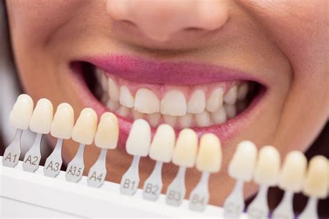 The Ultimate Guide to Resin Veneers: Transforming Your Smile in 2023 and Beyond