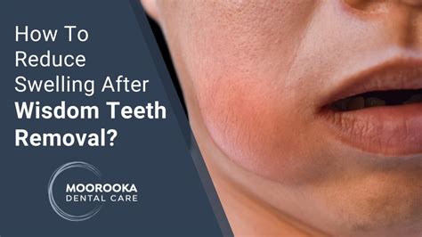 The average length of time that pain lasts after wisdom teeth removal is about 3-5 days.