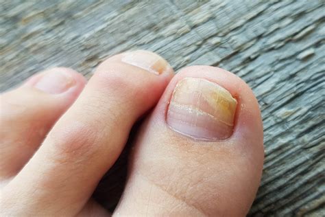 The most common pain points of toenail fungus include: