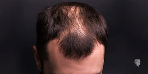 The reality is that shaving your hair does not affect the underlying causes of balding.