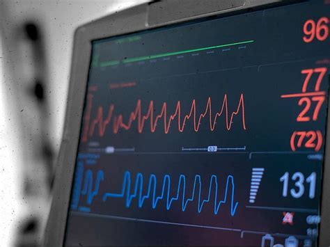 Theory and Practice of Intra-Aortic Balloon Pump Therapy Doc