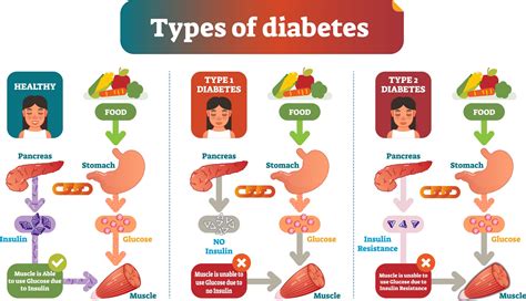 There are two main types of diabetes: