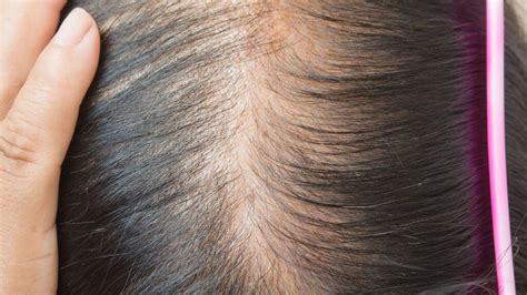 Thin Hair, A Common Concern