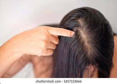 Thin Hair: A Growing Problem