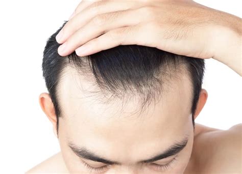 Thinning Hair: A Common Problem