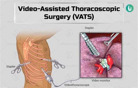 Thoracoscopic Surgery Epub