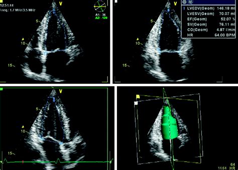 Three-dimensional Echocardiography Kindle Editon