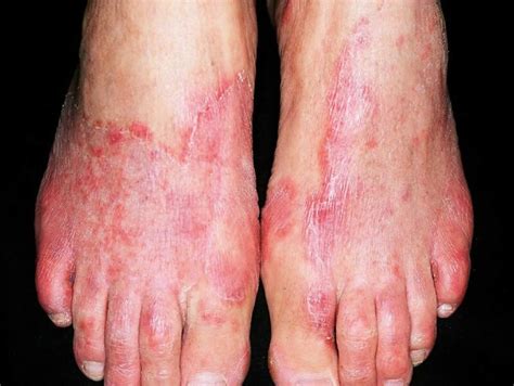 Tinea pedis (Athlete's foot)