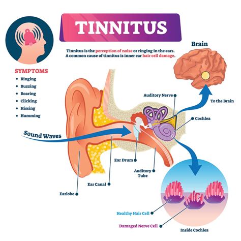 Tinnitus; Facts Reader