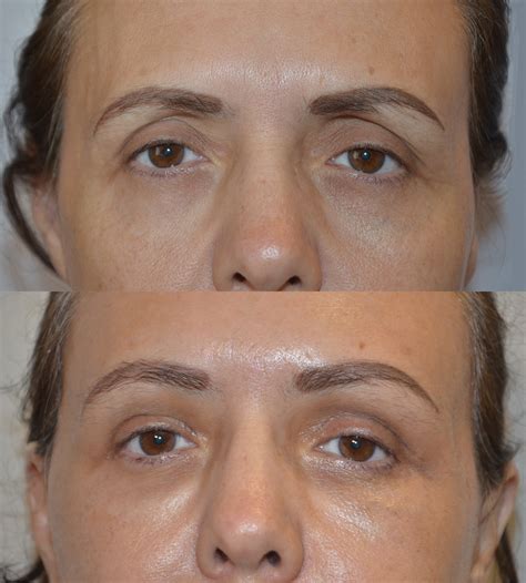 Tipos de Blefaroplastia