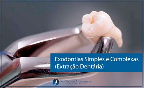 Tipos de Exodontias