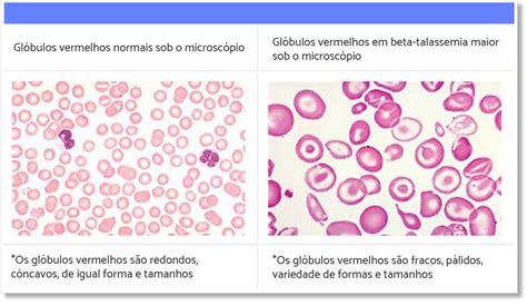 Tipos de Talassemia Beta