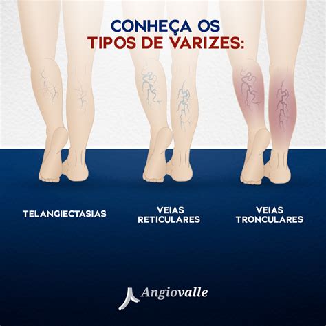 Tipos de Varizes