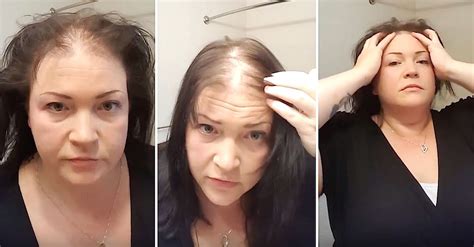 To cover up hair loss.