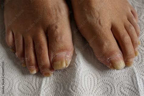 Toenails: The Neglected Aspect of Foot Health