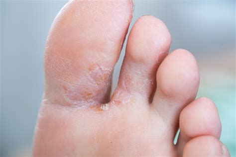 Toenails Falling Off: A Sign of Cancer You Shouldn't Ignore