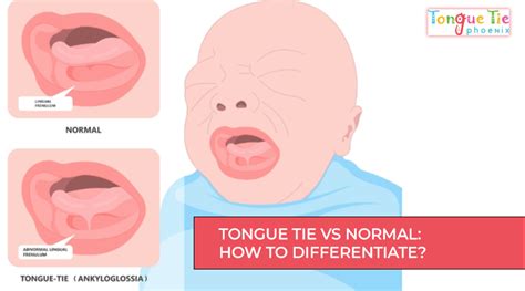 Tongue Tie vs Normal Pictures: 5 Key Differences