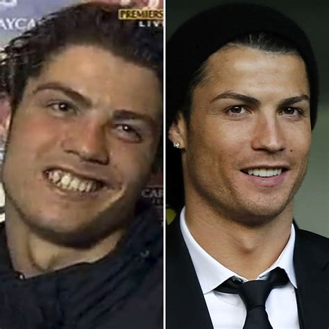 Tooth Celebrities: Rich Before and After