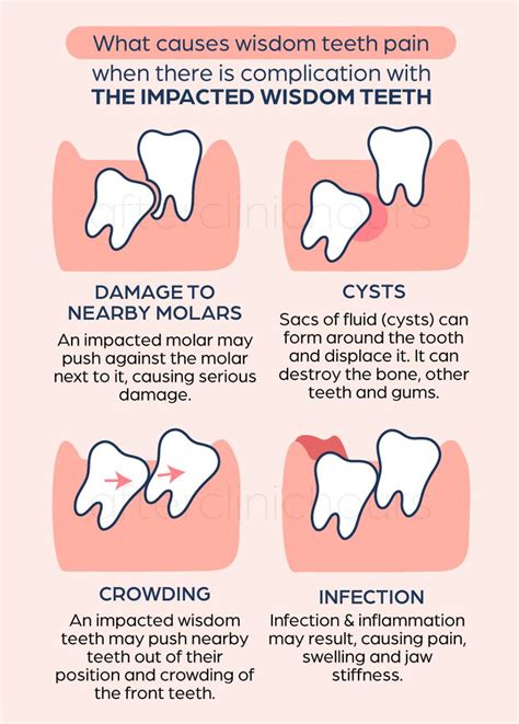 Tooth Extraction Cost Singapore: Guide 2023