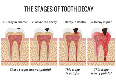 Tooth decay and cavities: