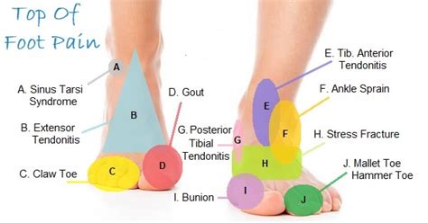 Top Foot Pain Chart