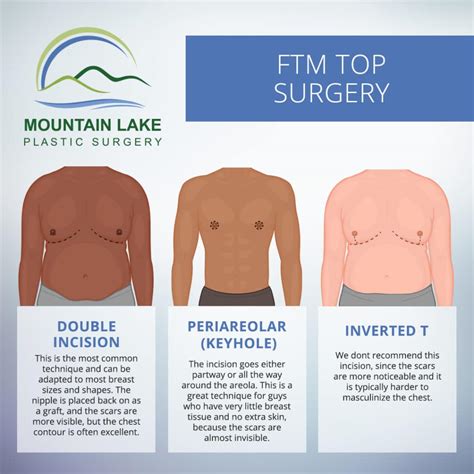 Top surgery: