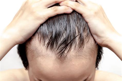 Toupee or Just Let It Go: Embracing or Escaping Hair Loss