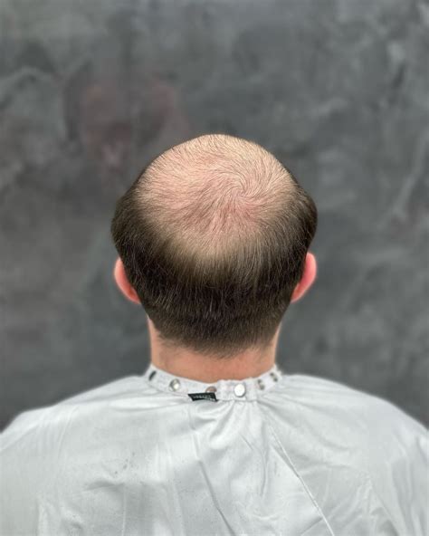 Toupee or Just Let It Go: The 10,000-Character Decision