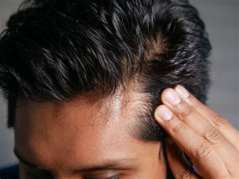 Toupees for Men: The Ultimate Solution for Hair Loss