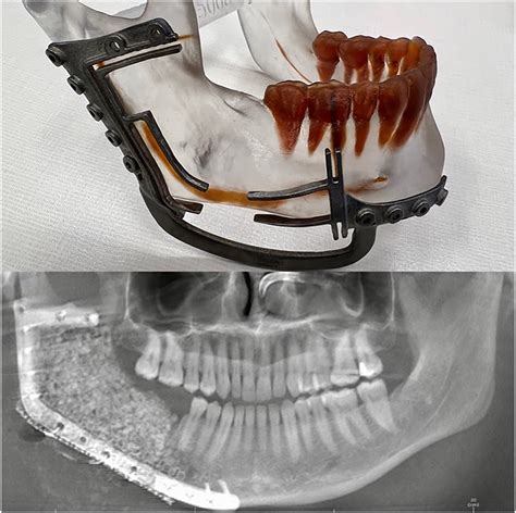 Toward Tissue Engineering in Maxillofacial Reconstruction Doc