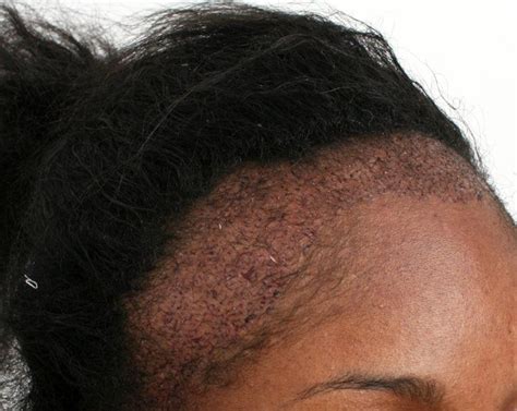 Traction alopecia: