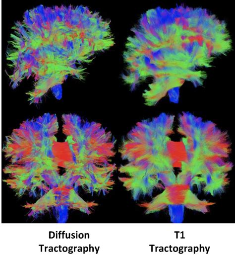 Tractography: