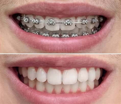 Traditional Braces: