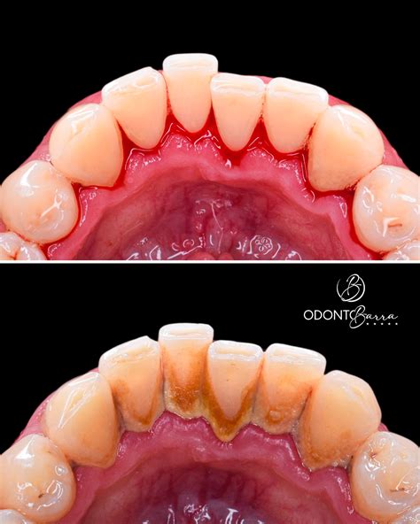 Transformação Sorridente: A Jornada da Limpeza Dentária Antes e Depois