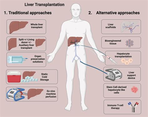 Transplantation of the Liver PDF