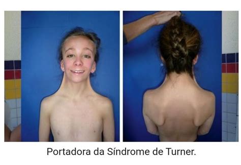 Tratamentos para Síndrome de Turner