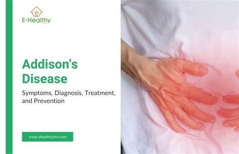 Treatment for Addison's Disease: 7 Essential Strategies