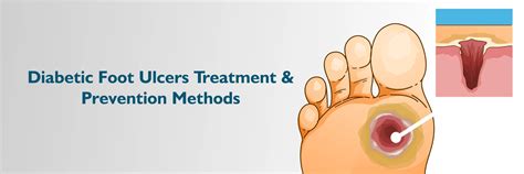 Treatment for Diabetic Foot Ulcers