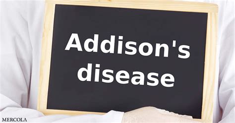 Treatment of Addison's Disease: A Comprehensive 360-Degree Guide