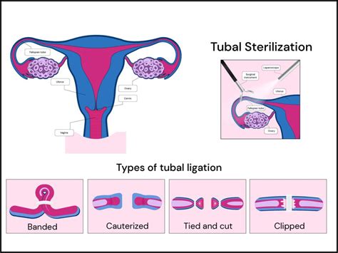 Tubal Ligation vs. Hysterectomy: 15 Key Differences Explained