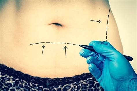 Tummy Tuck: Comprehensive Guide to Cost, Benefits, and Considerations