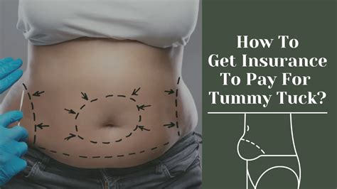 Tummy Tuck Covered by Insurance: A Comprehensive Guide in 2023